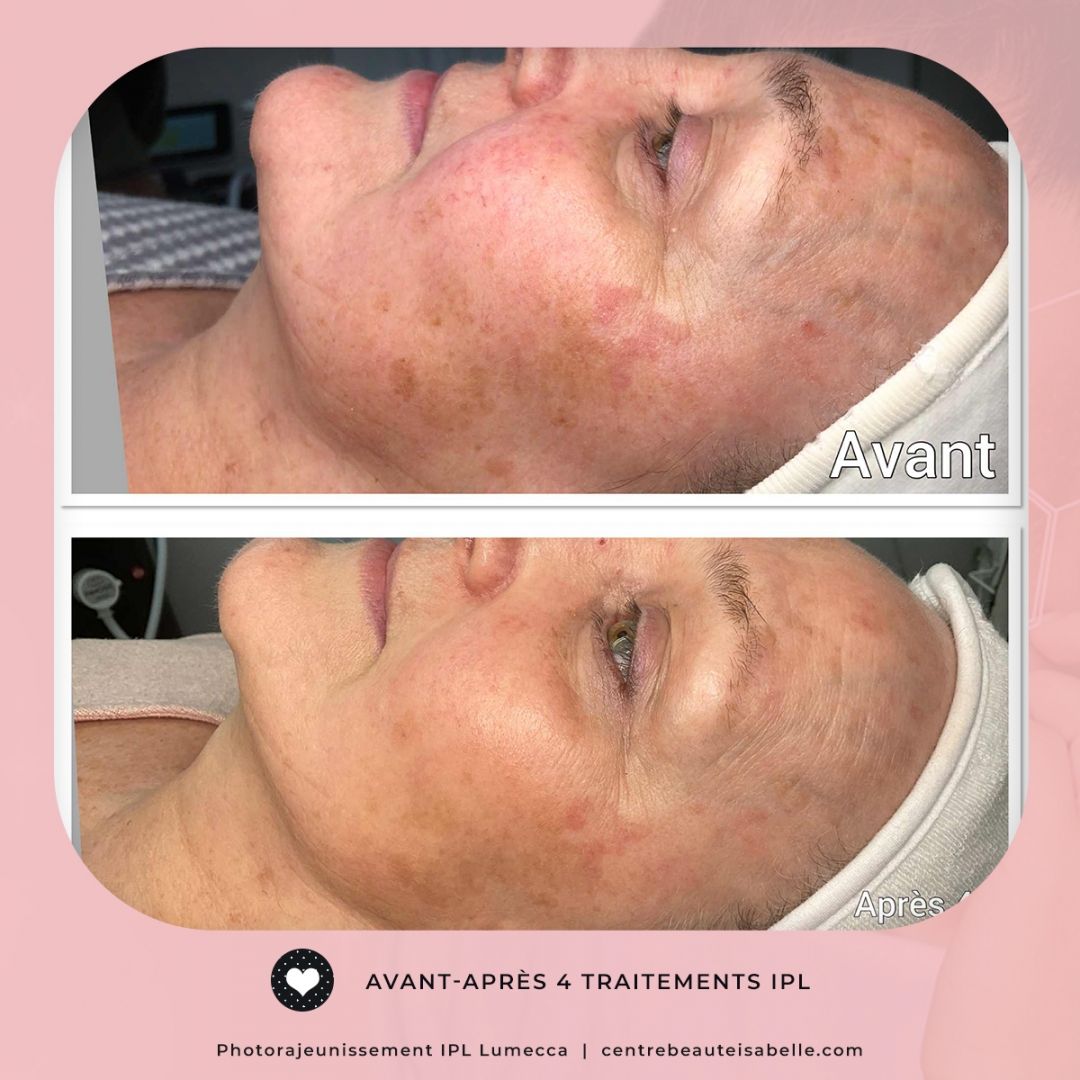 avant-après lumecca Centre Beauté Isabelle