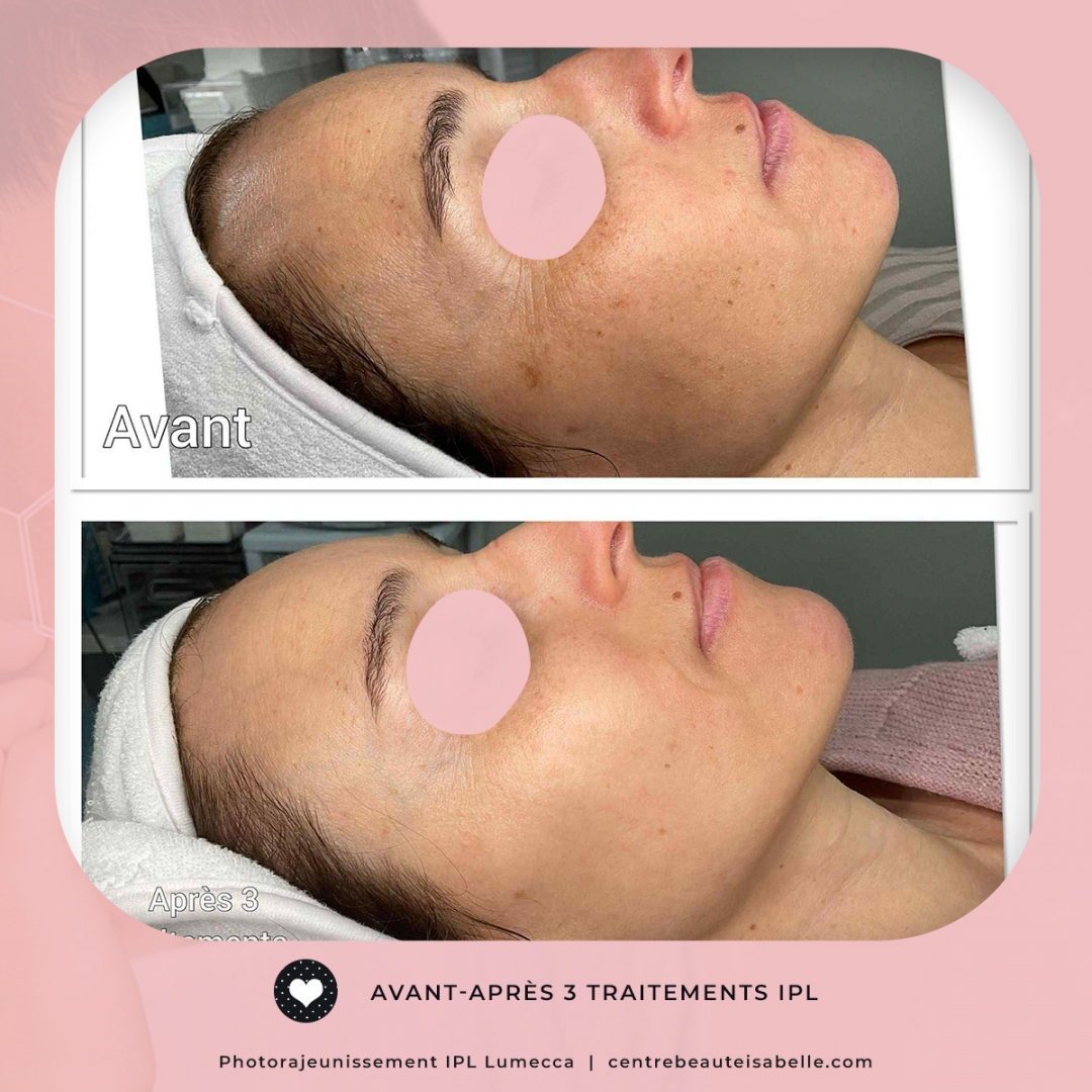 avant-après lumecca Centre Beauté Isabelle