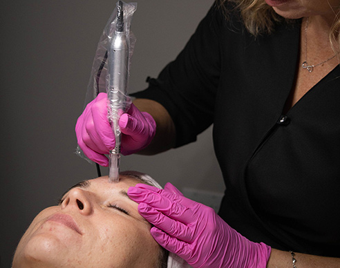 microneedling Isabelle Côté