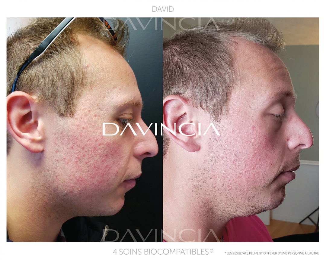 Davincia avant-après homme acné
