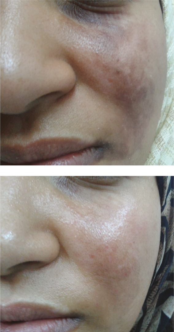 microneedling Fusion avant-après