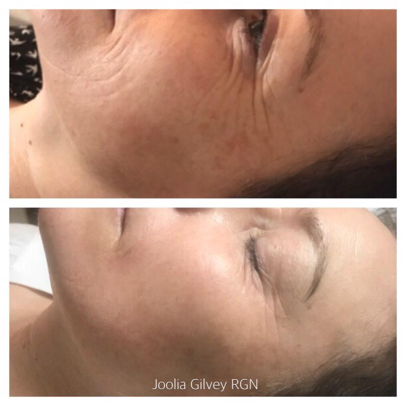 microneedling Fusion avant-après