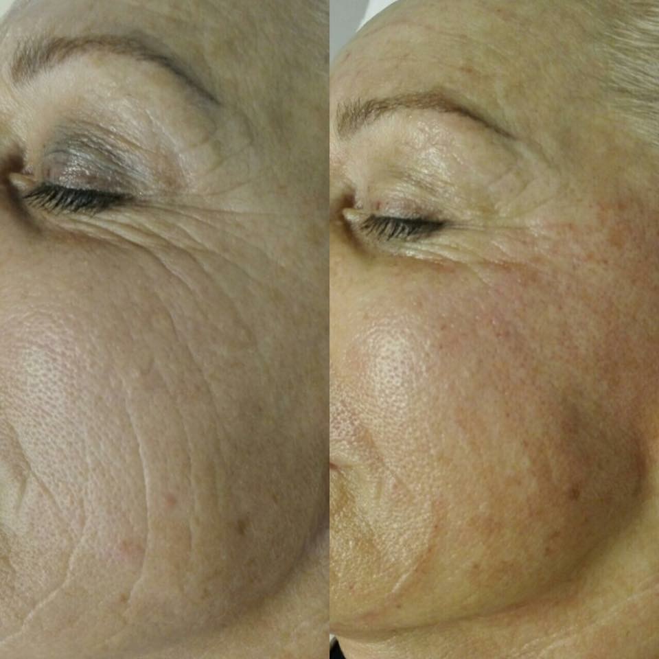 microneedling Fusion avant-après