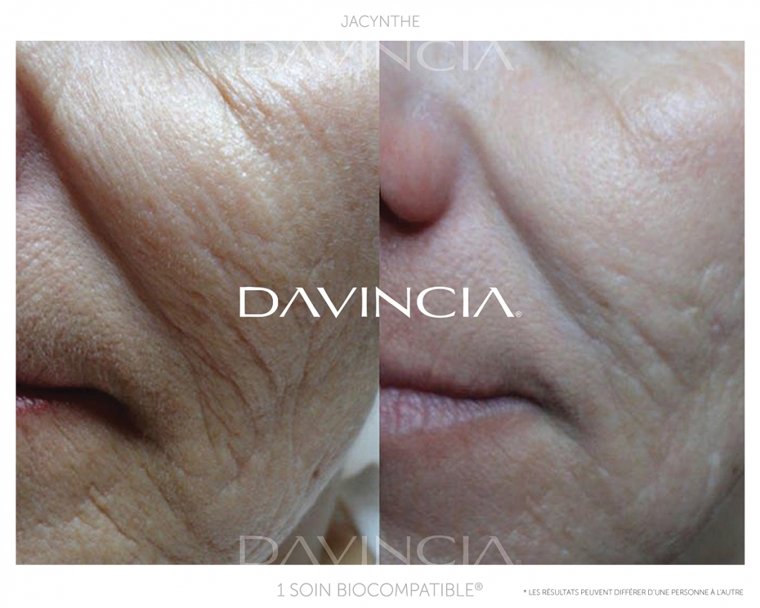 Peeling Davincia avant-apres 1 soin