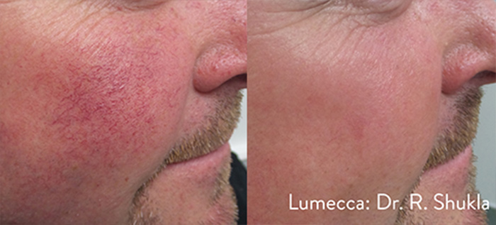 lumecca IPL avant-après visage homme