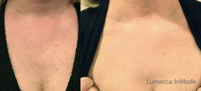 lumecca IPL avant-après décolleté